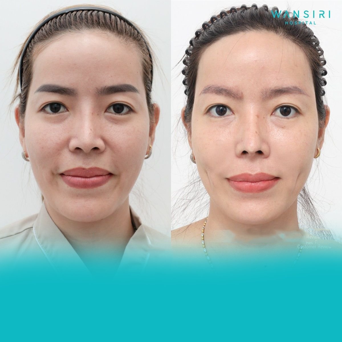 Before and after dimple creation surgery results at Wansiri Hospital, enhanced cheek dimples
