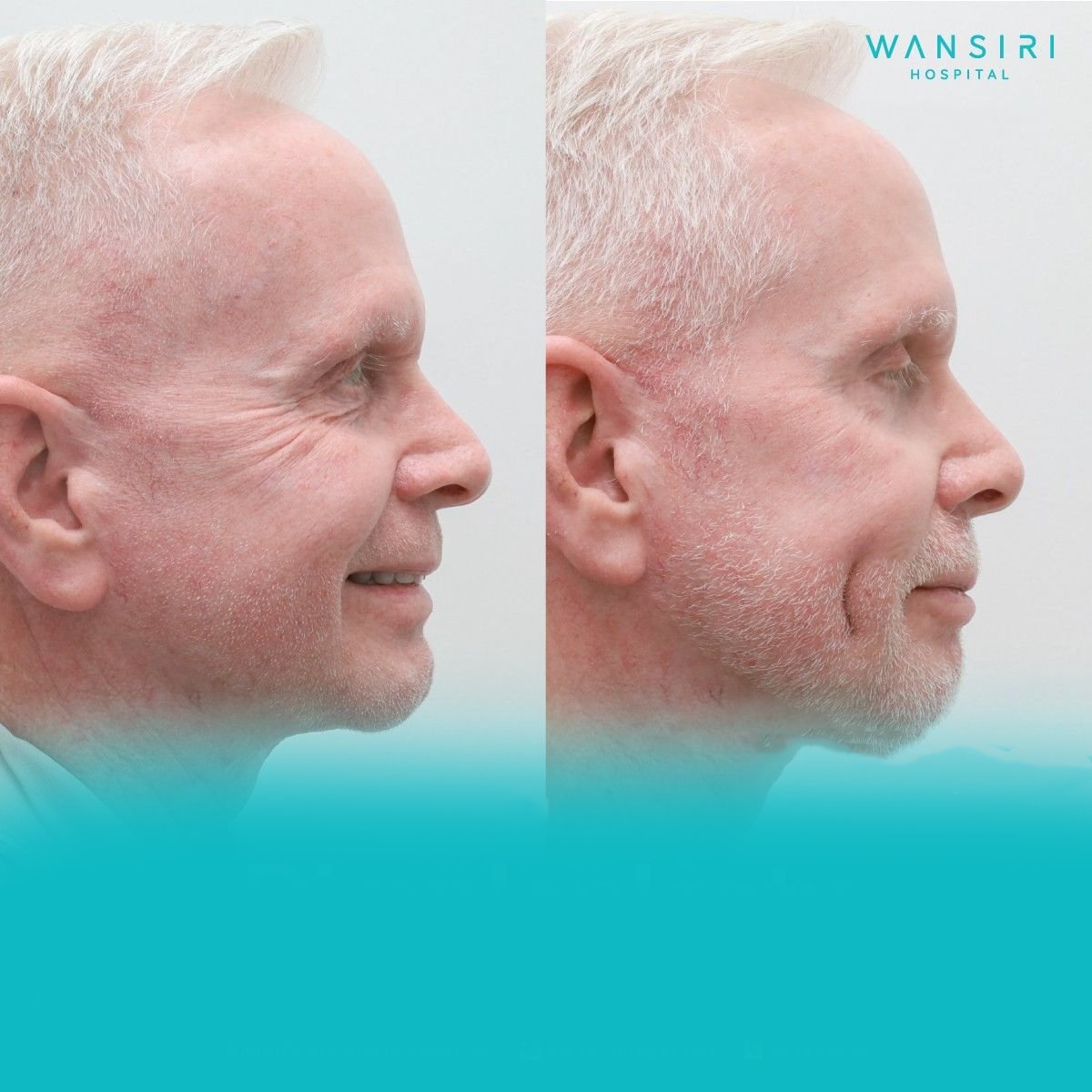 Résultats avant/après chirurgie des fossettes à Wansiri Hospital, fossettes accentuées