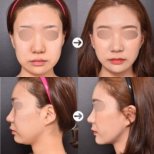 Fotos vor und nach Fettabsaugung durch Dr. Park Sangwook 
