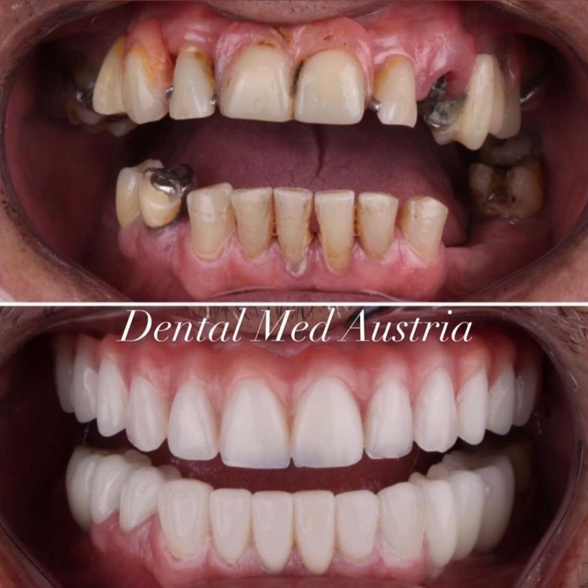 نتيجة قبل وبعد زراعة الأسنان All-on-6 في عيادة Dental Med Austria & Elixence