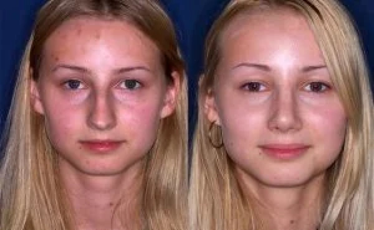 نتائج عملية تجميل الأنف قبل وبعد، تحسين طبيعي لشكل الأنف
