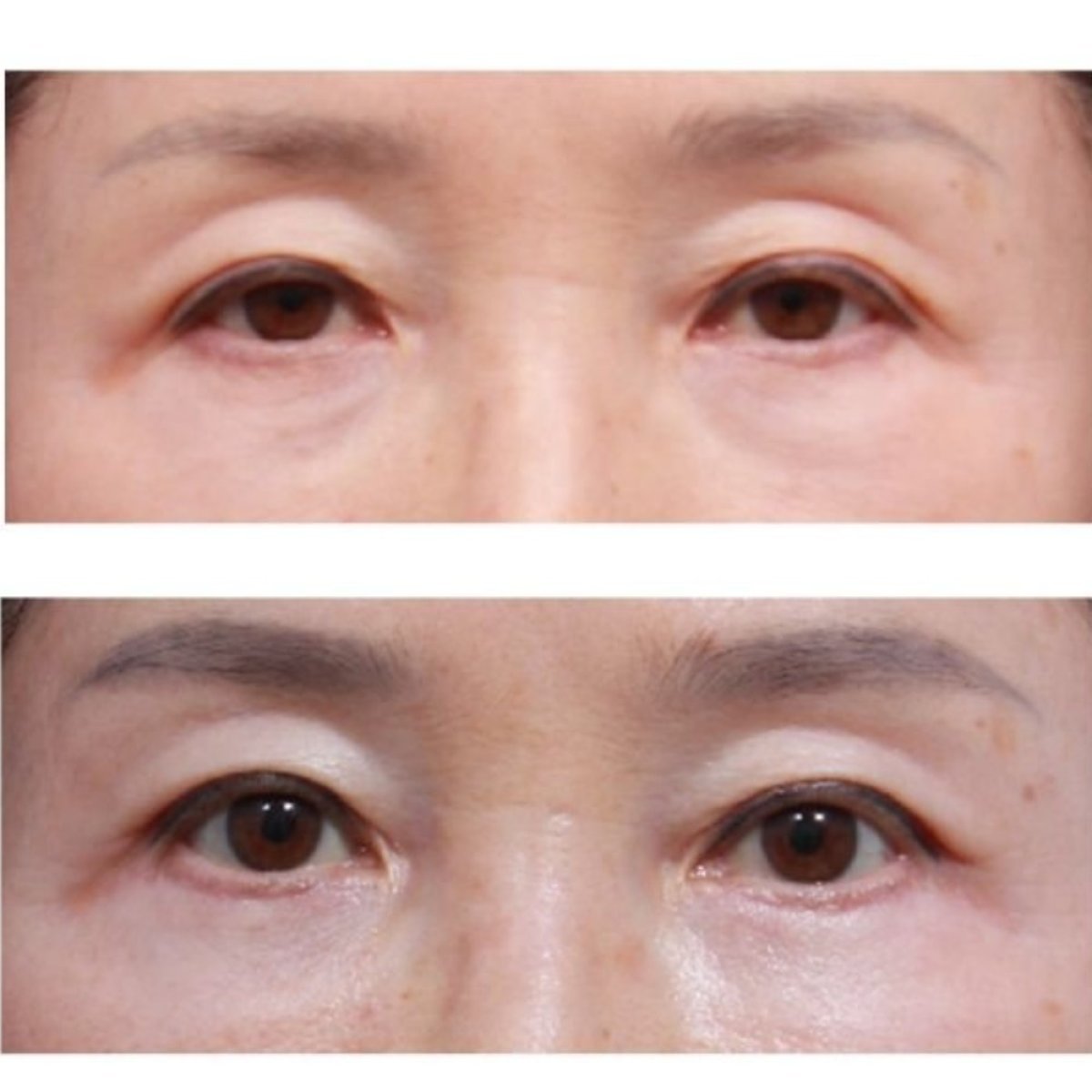 Before and after lower eyelid blepharoplasty results at Returning Plastic Surgery clinic