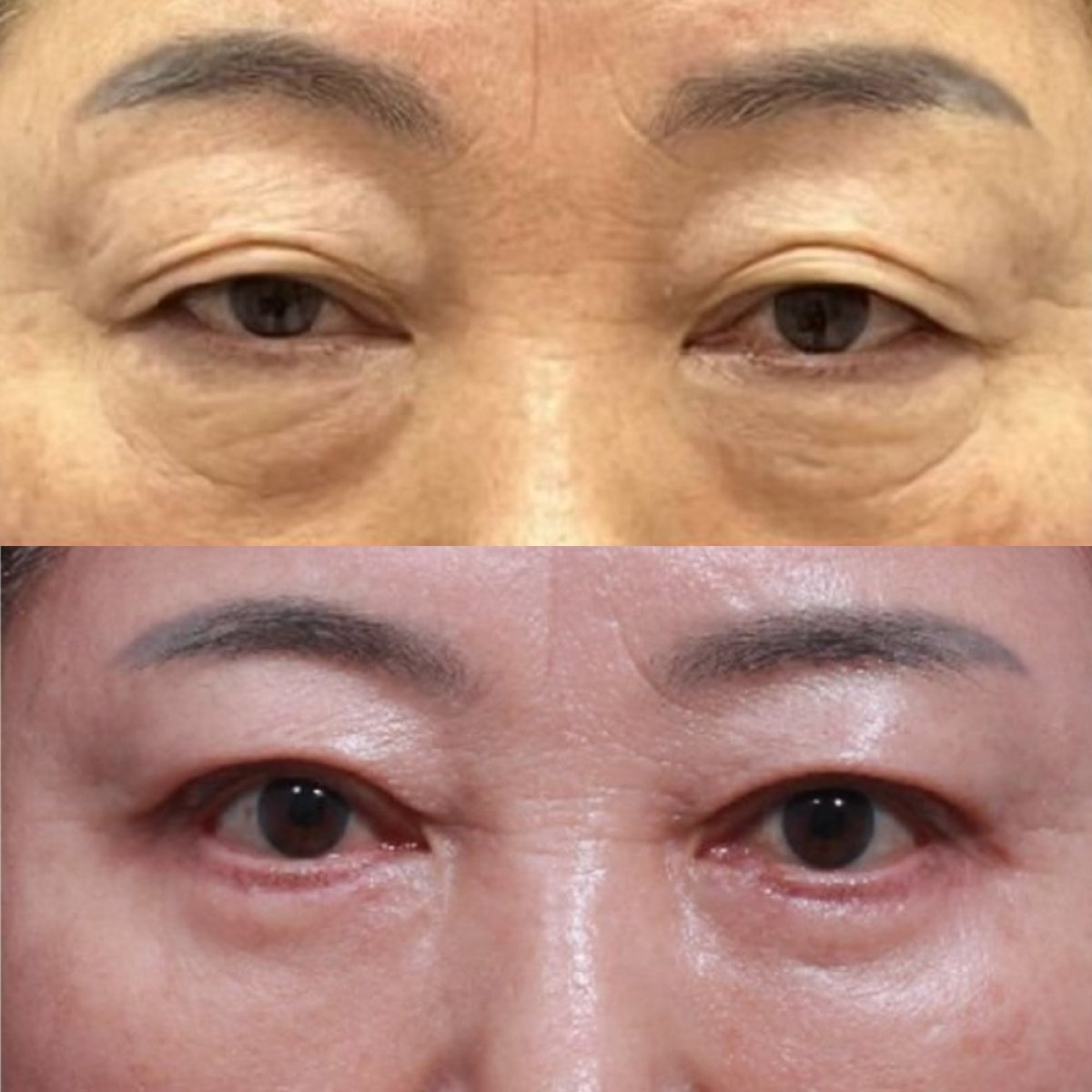 Before and after lower eyelid blepharoplasty results at Returning Plastic Surgery clinic