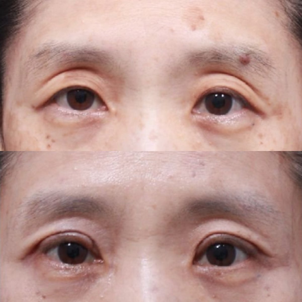 Before and after lower eyelid blepharoplasty results at Returning Plastic Surgery clinic