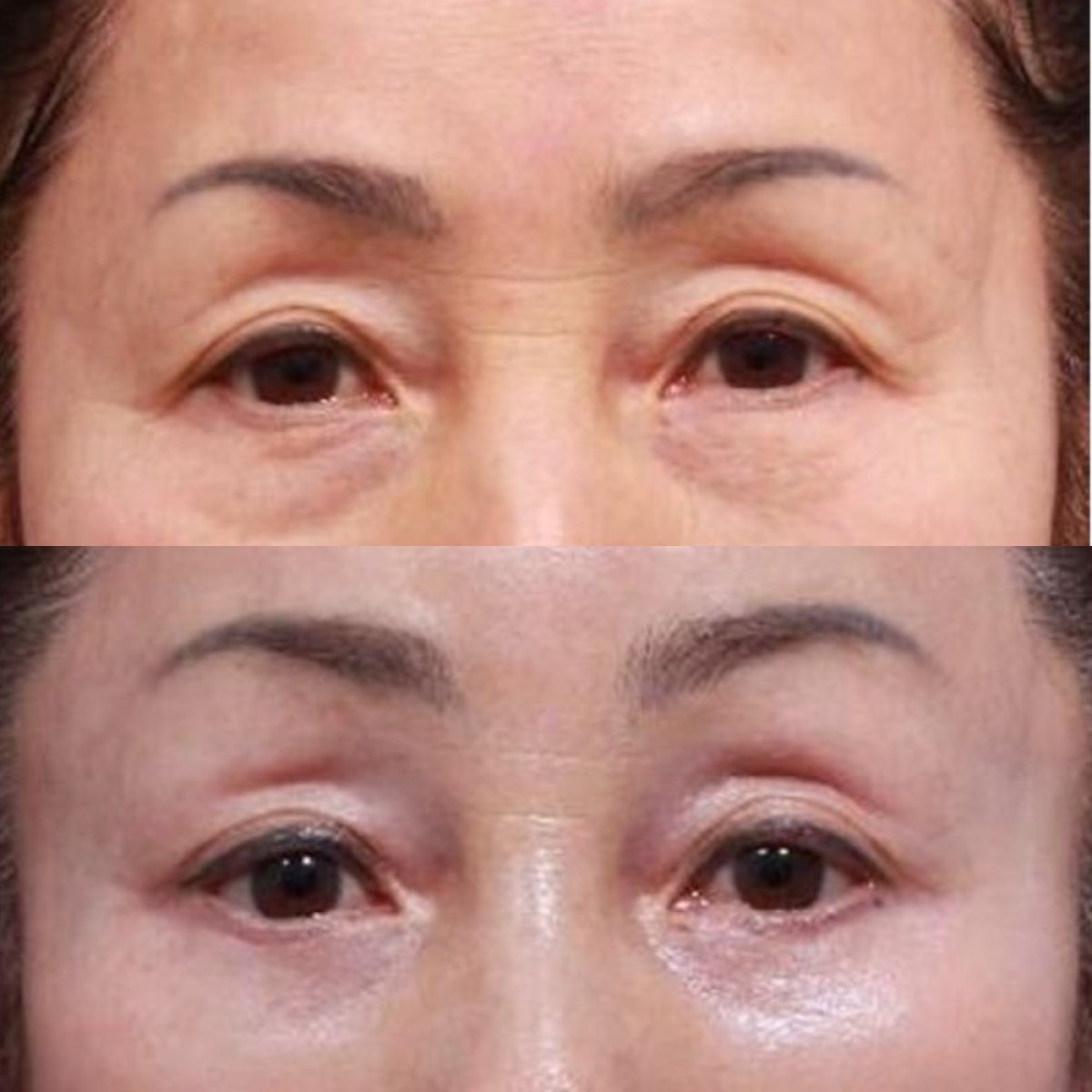 Before and after lower eyelid blepharoplasty results at Returning Plastic Surgery clinic