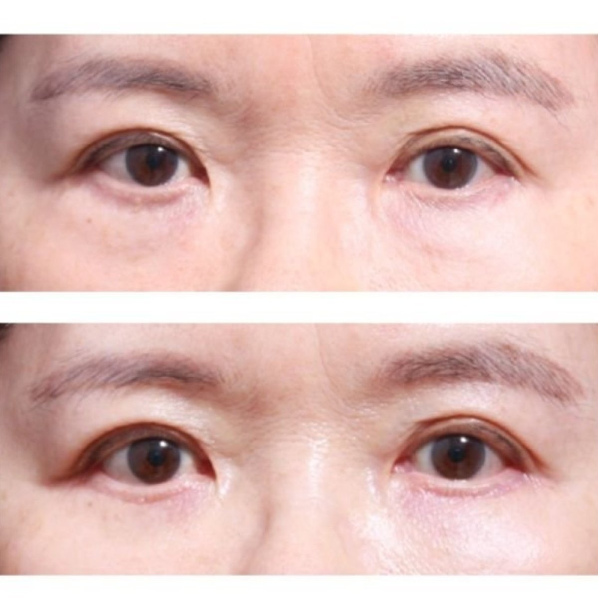Before and after lower eyelid blepharoplasty results at Returning Plastic Surgery clinic