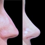 Fotos vor und nach Rhinoplastik (Nasenkorrektur) durch Dr. 