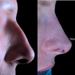 Fotos vor und nach Rhinoplastik (Nasenkorrektur) durch Dr. 