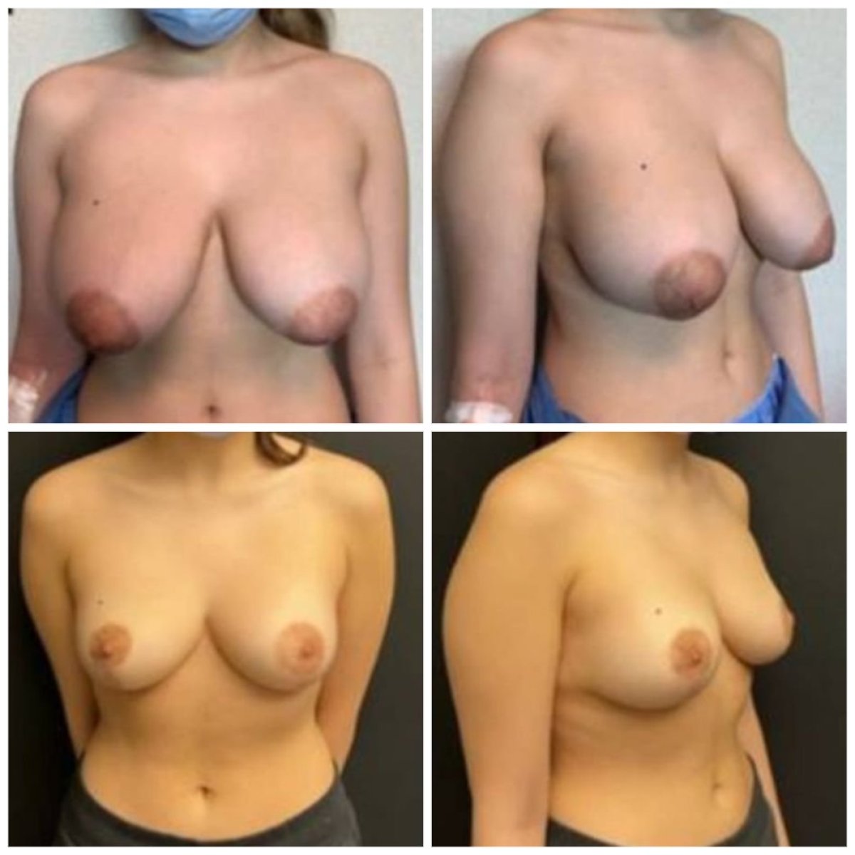 Before and after breast lift results at Memorial Şişli Hospital, improved breast shape and contour