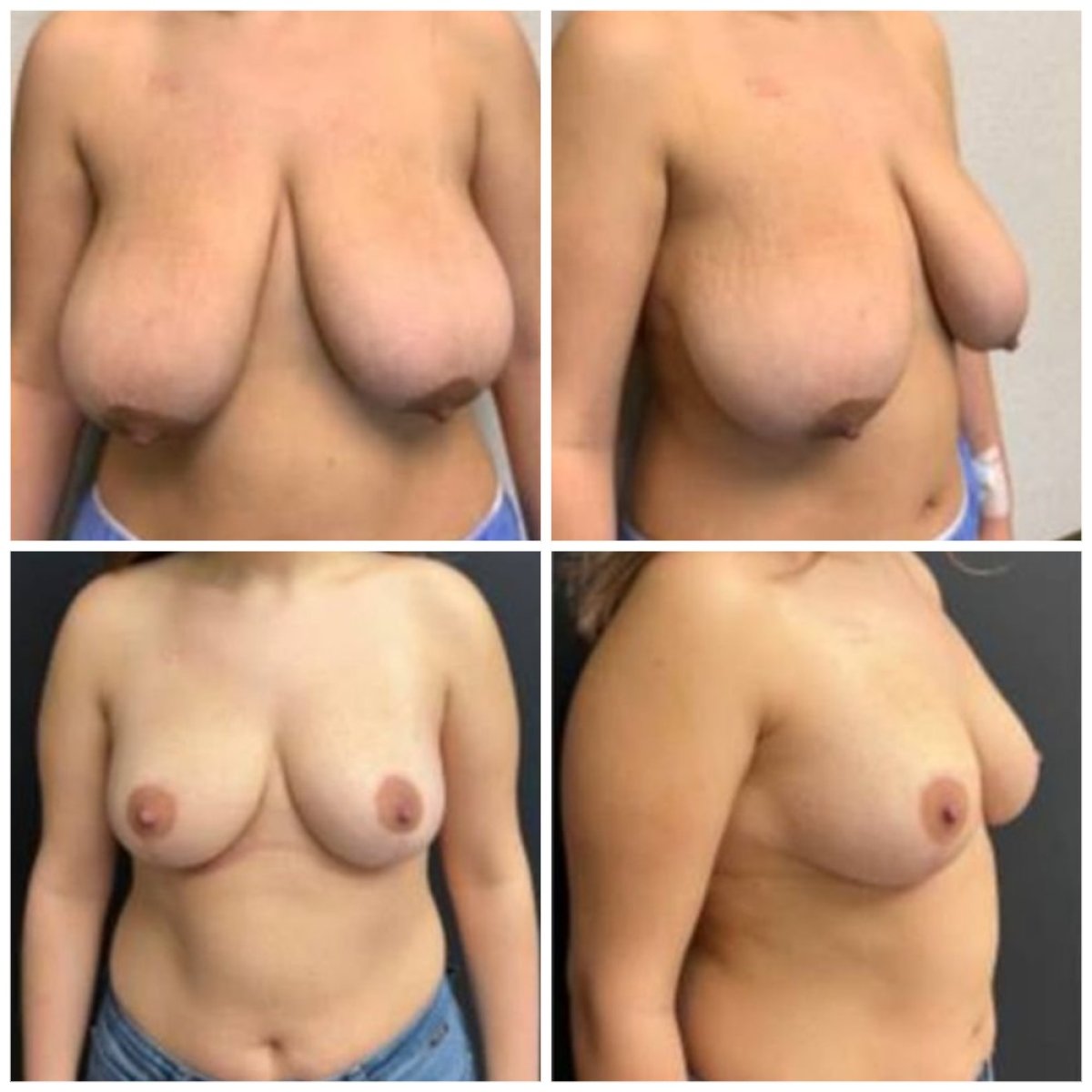 Resultados de lifting de senos antes y después en Memorial Şişli Hospital, mejor contorno
