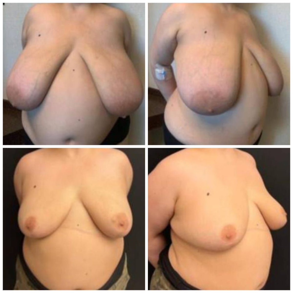 Before and after breast lift results at Memorial Şişli Hospital, improved breast contour