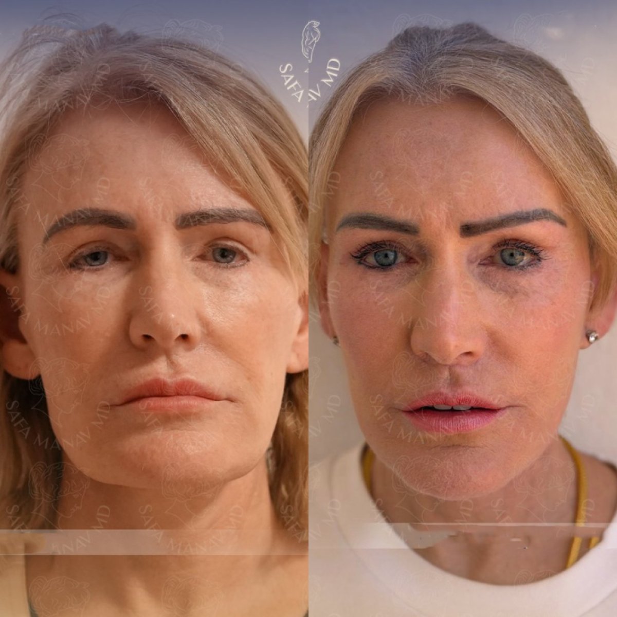Результаты до и после deep plane facelift в клинике Dr. Safa Manav, омоложение лица