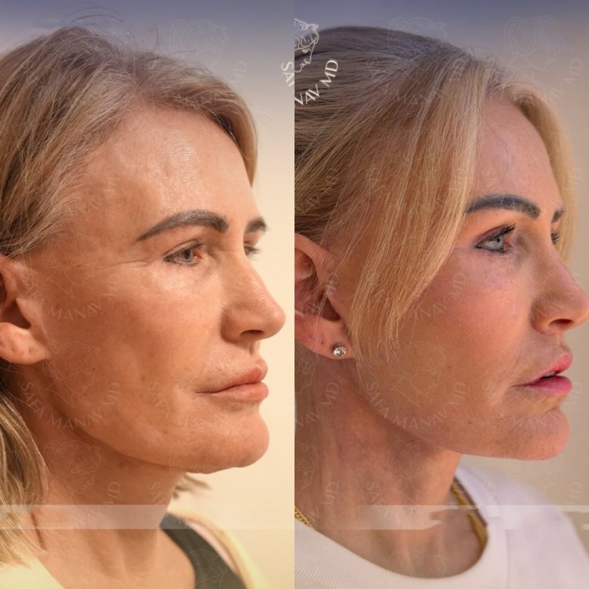 Résultats avant/après lifting deep plane à la clinique Dr. Safa Manav, rajeunissement du visage