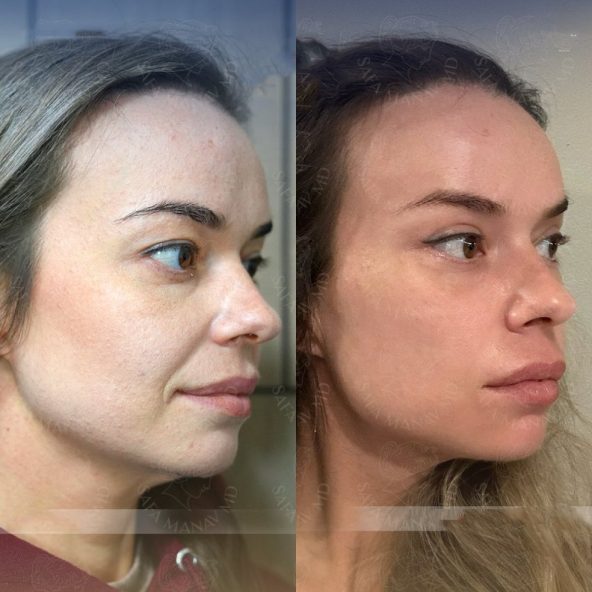 Resultados antes y después de deep plane facelift en Dr. Safa Manav Clinic, rejuvenecimiento facial