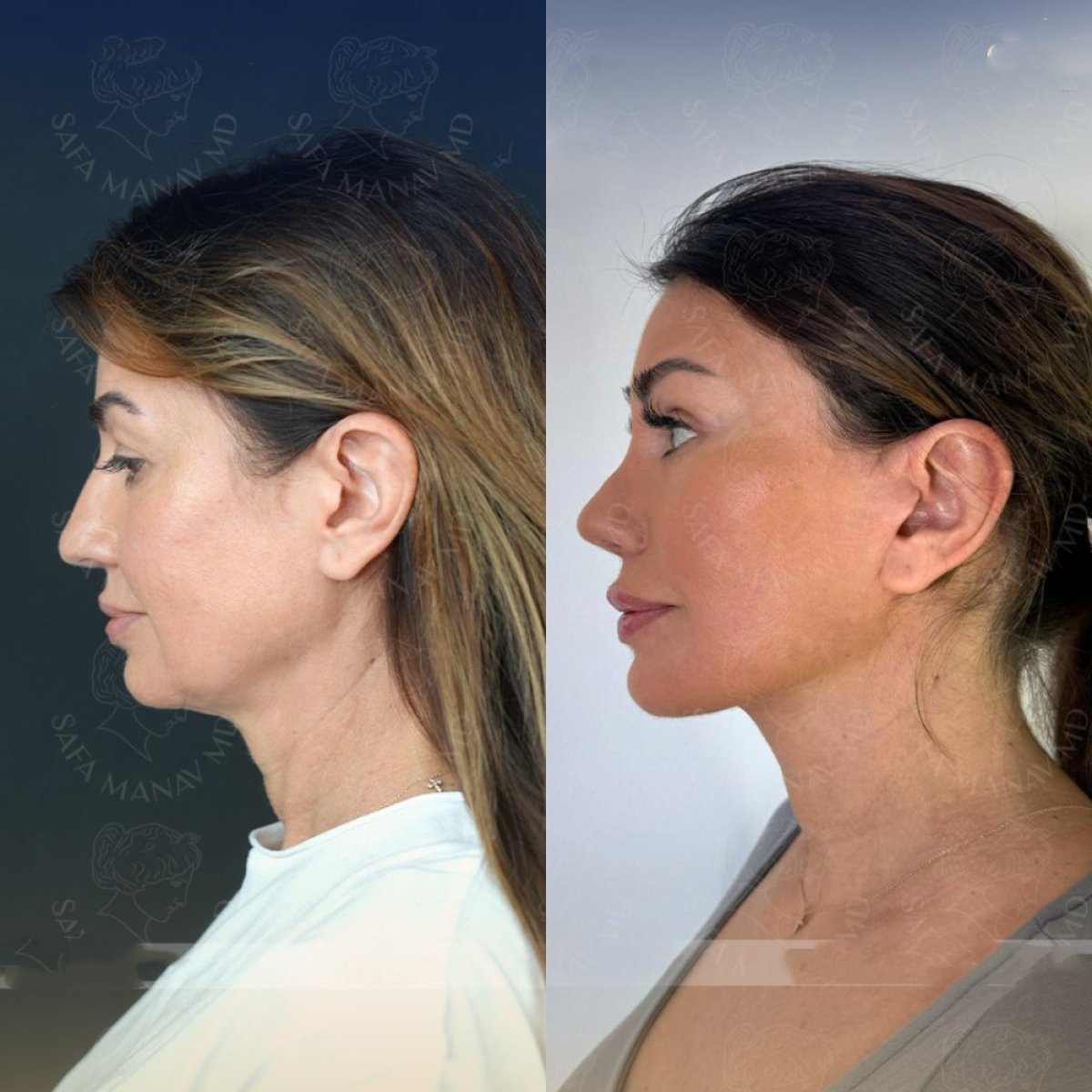 Before and after deep plane facelift results at Dr. Safa Manav Clinic, visible facial rejuvenation