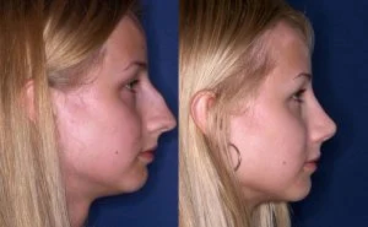نتائج تجميل الأنف قبل وبعد، إعادة تشكيل الأنف لتحسين ملامح الوجه