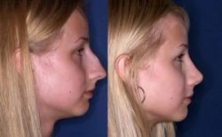 Fotos vor und nach Rhinoplastik (Nasenkorrektur) durch Dr. Michal Krawczynski