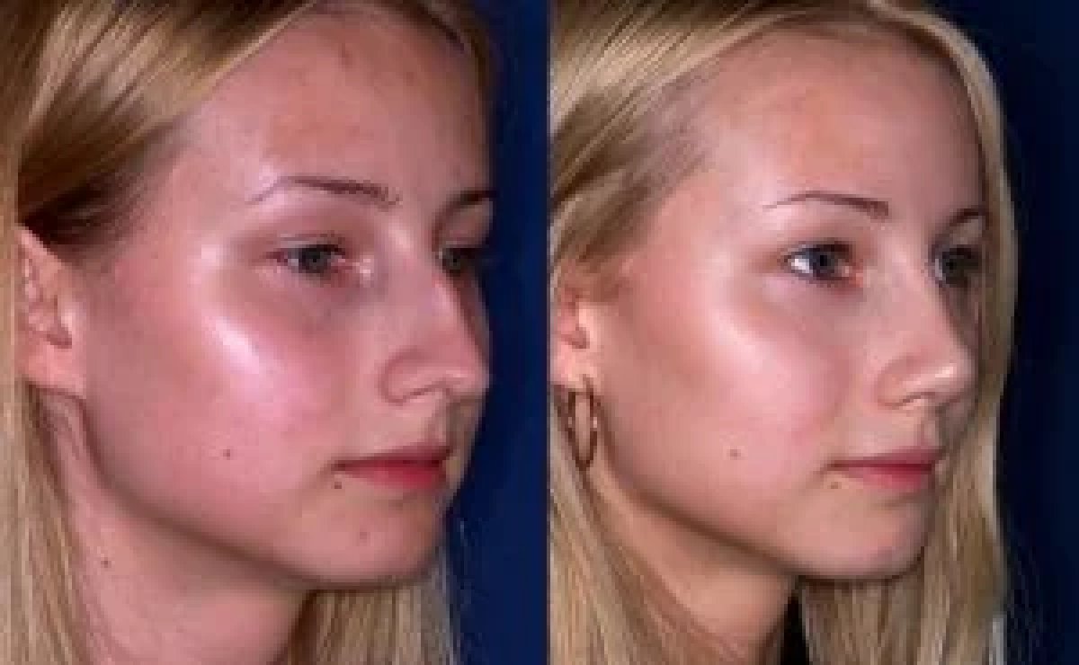 نتائج عملية تجميل الأنف قبل وبعد – تحسين طبيعي لشكل الأنف الجانبي