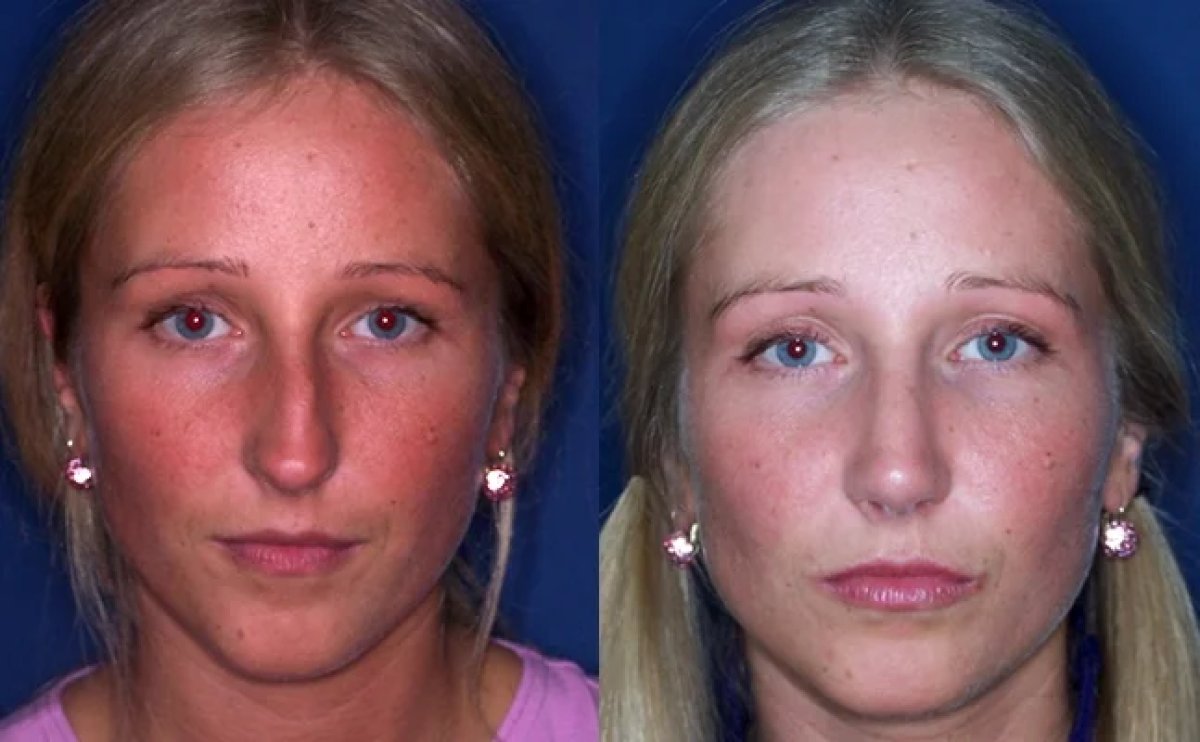 نتائج عملية تجميل الأنف قبل وبعد، إعادة تشكيل الأنف بنتيجة طبيعية لمريضة