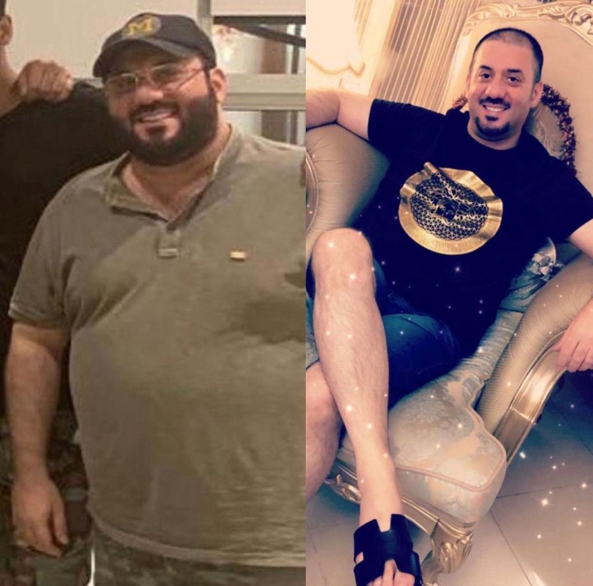 Before and after gastric balloon results – significant weight loss and body transformation