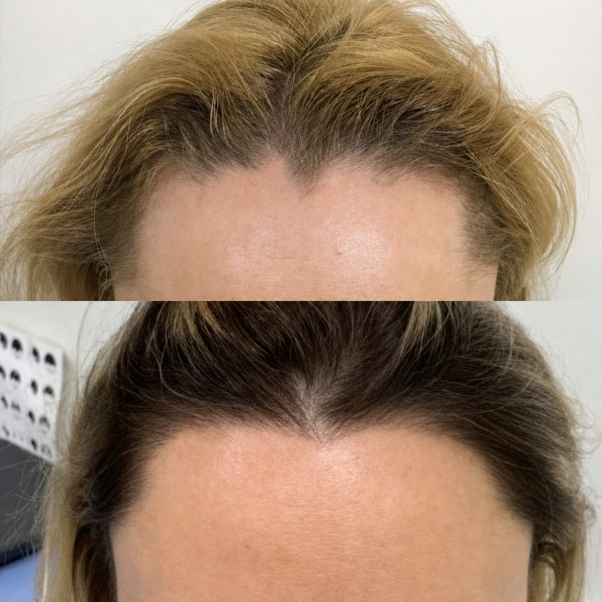Before and after female hair transplant result at Hair Clinic PRIVÉ – restored hairline