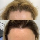 Hair transplant results by Dr. - Patient’s before and after images Before and after Hair transplant photos by Dr.