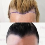 Hair transplant results by Dr. - Patient’s before and after images Before and after Hair transplant photos by Dr.