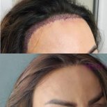 Hair transplant results by Dr. - Patient’s before and after images Before and after Hair transplant photos by Dr.