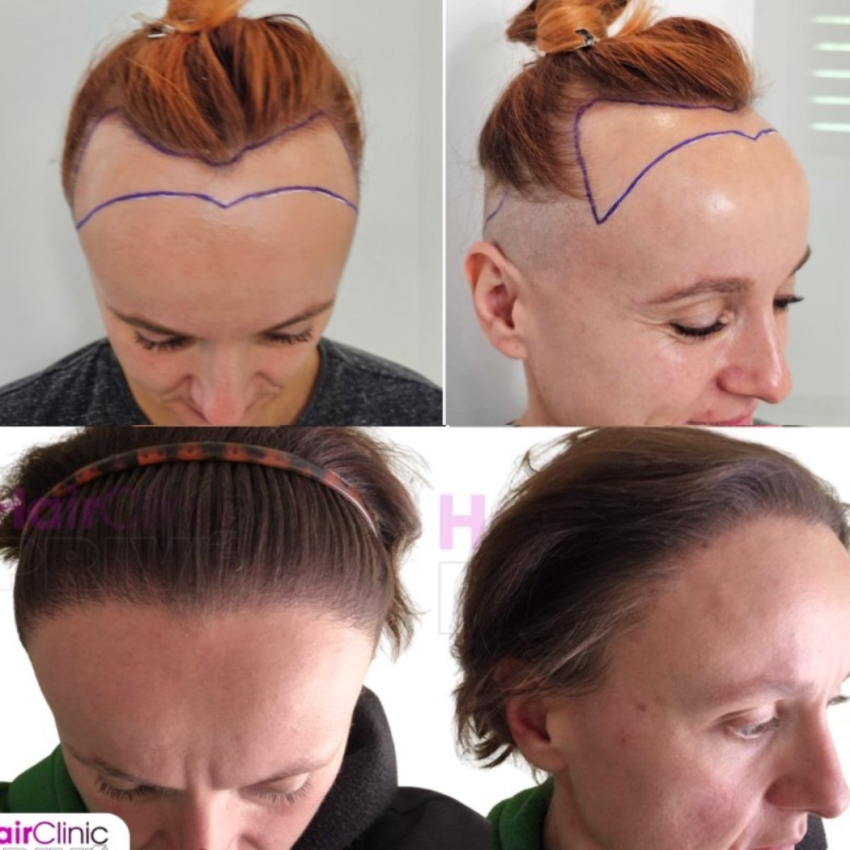 Female hair transplant before and after results at Hair Clinic PRIVÉ – restored hairline