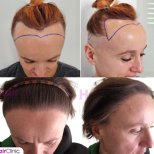 Hair transplant results by Dr. - Patient’s before and after images Before and after Hair transplant photos by Dr.