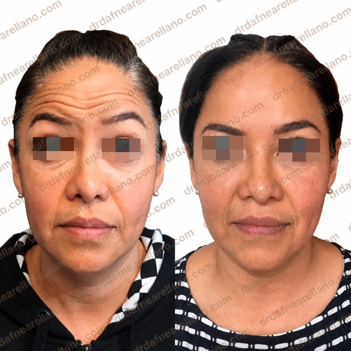 Before and after Botox for forehead wrinkles at Dr. Arellano clinic, smoother skin result