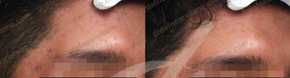 نتائج علاج ندبات حب الشباب على الجبهة قبل وبعد، بشرة أكثر نعومة في العيادة