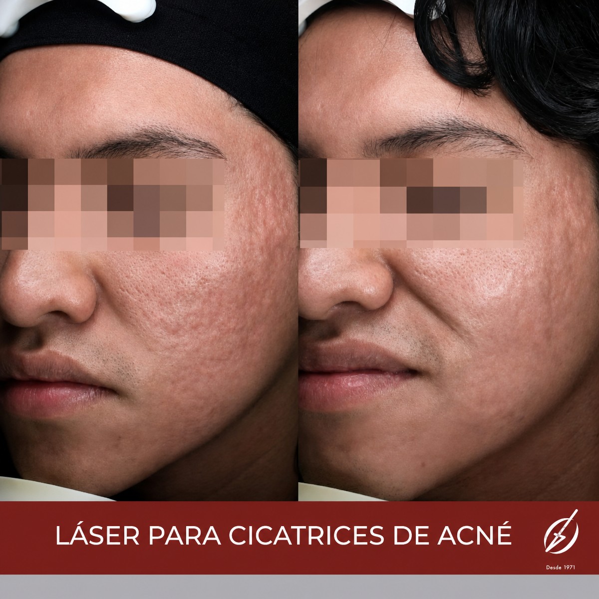 Before and after acne scar laser treatment results, smoother skin texture improvement