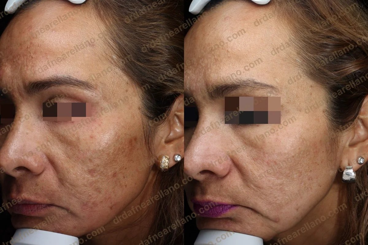 CO2 laser treatment before and after results – improved facial skin texture and pigmentation