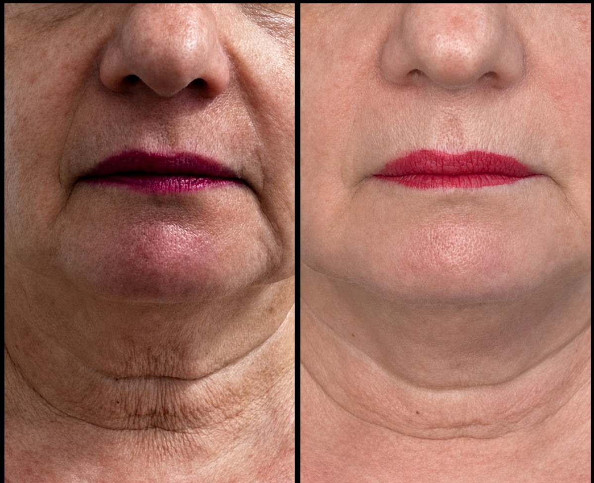 Before and after nonsurgical facelift results – smoother jawline and reduced neck wrinkles