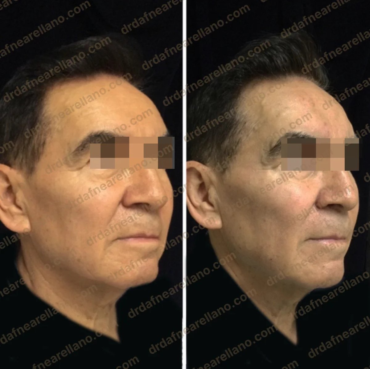 Before and after nonsurgical facelift results, visible facial rejuvenation and tighter jawline