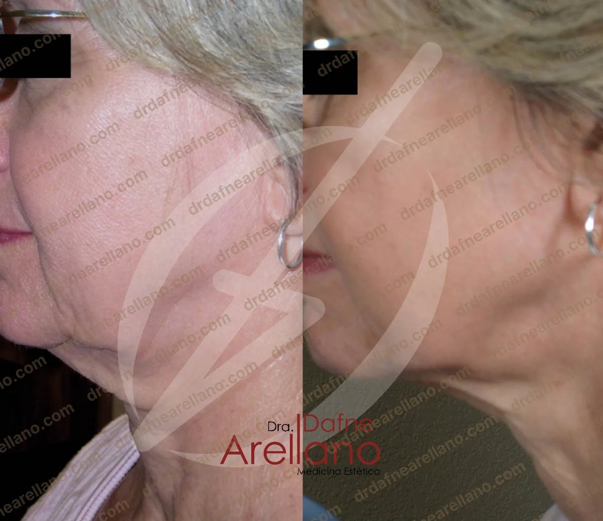 Before and after nonsurgical facelift results at Dra. Dafne Arellano, visible skin tightening