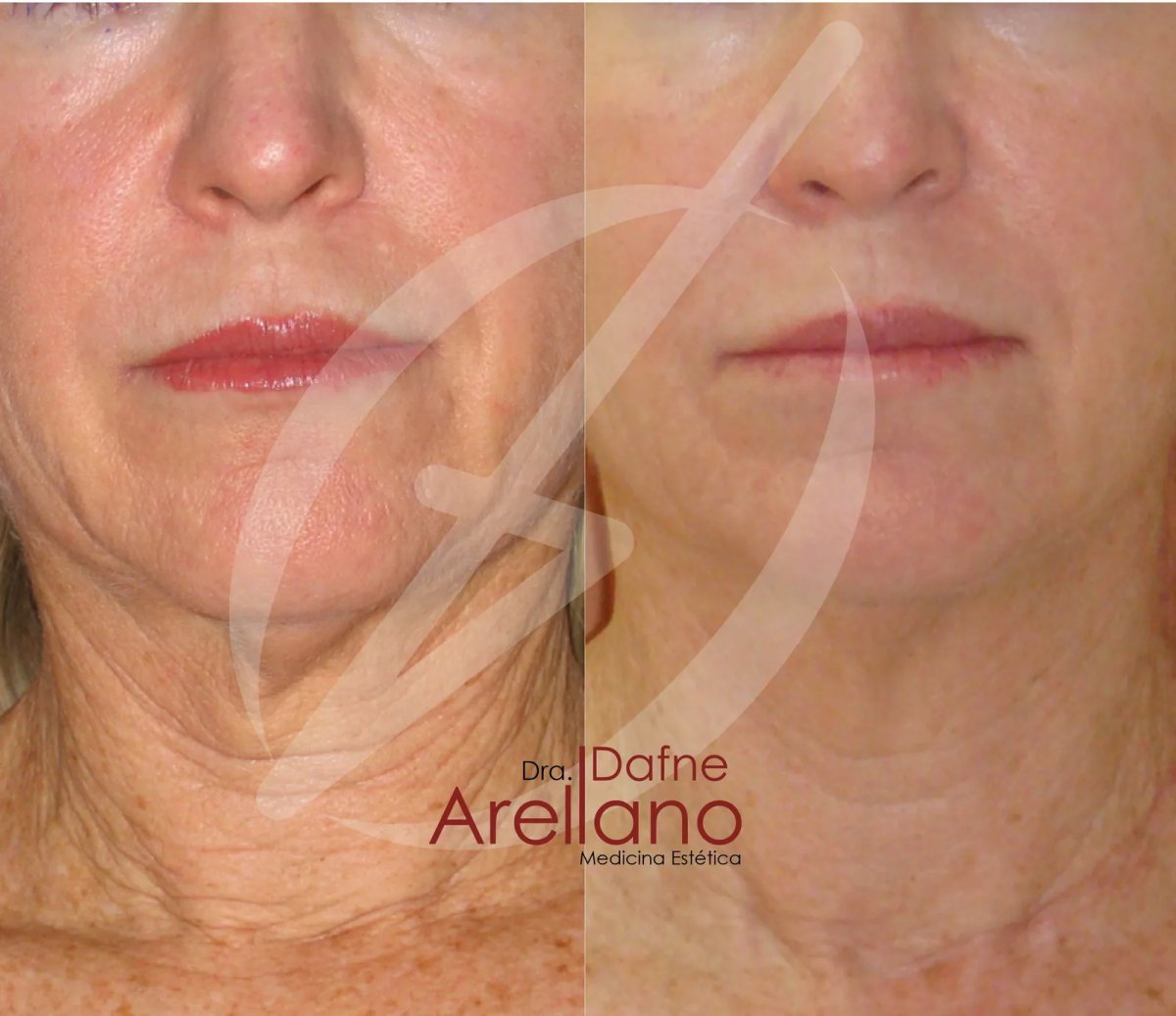 Resultados antes y después de lifting facial sin cirugía con Dra. Dafne Arellano