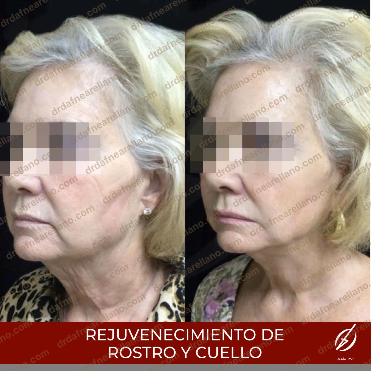 Resultados antes y después de lifting facial y de cuello, rejuvenecimiento visible