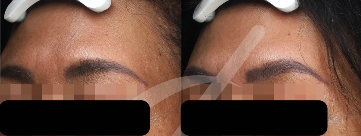 Microneedling forehead before and after results – smoother skin texture improvement