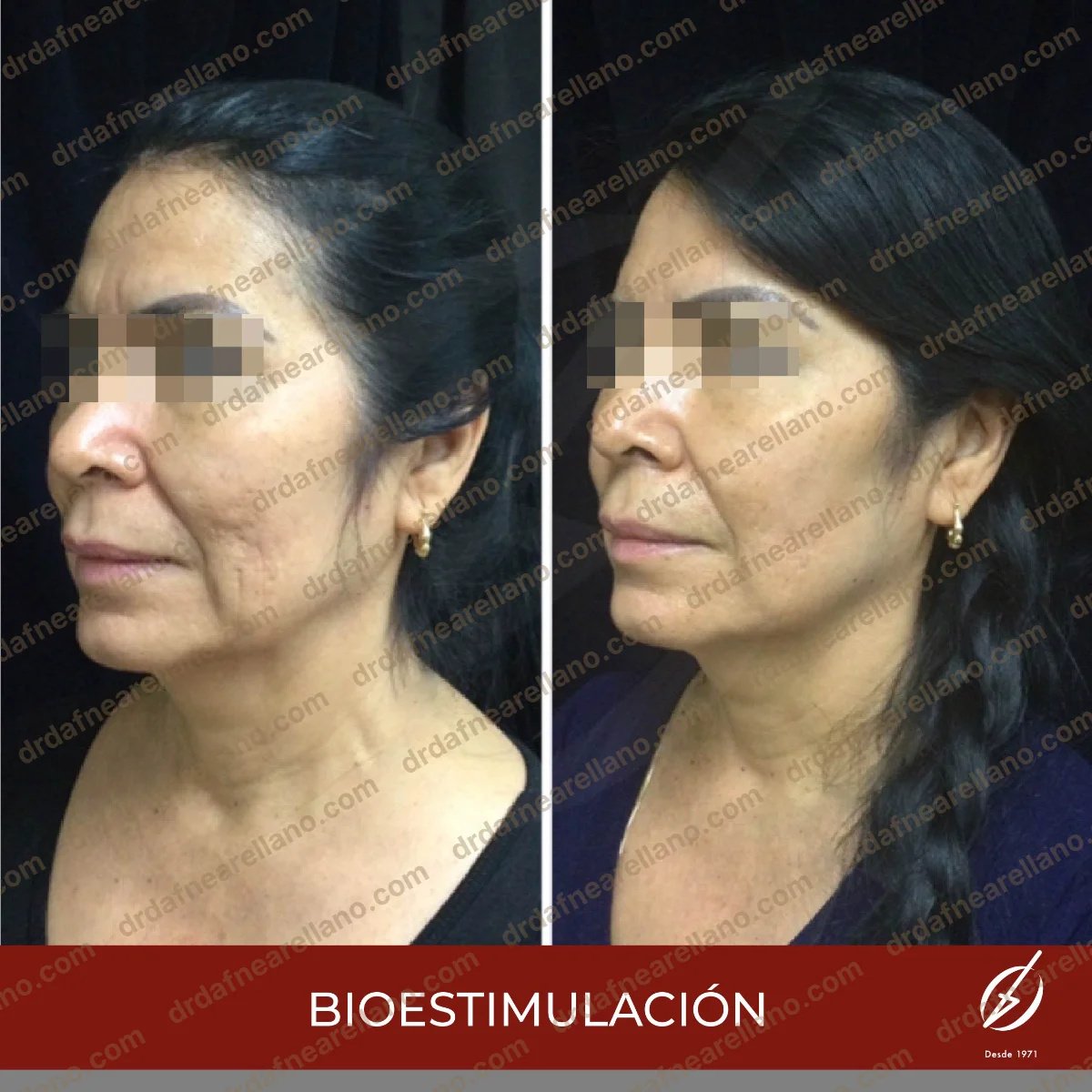 Vorher-nachher-Ergebnisse der Gesichtsbiostimulation in der Klinik Dra. Fine Arellano