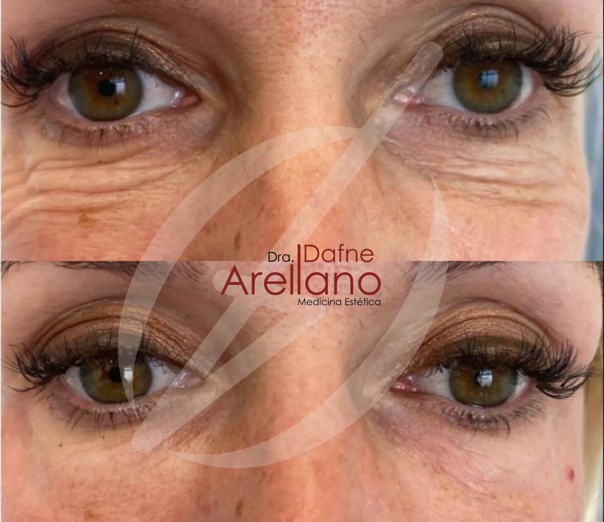 Botox injections before and after results at Dra. Dafne Arellano, reduced eye wrinkles
