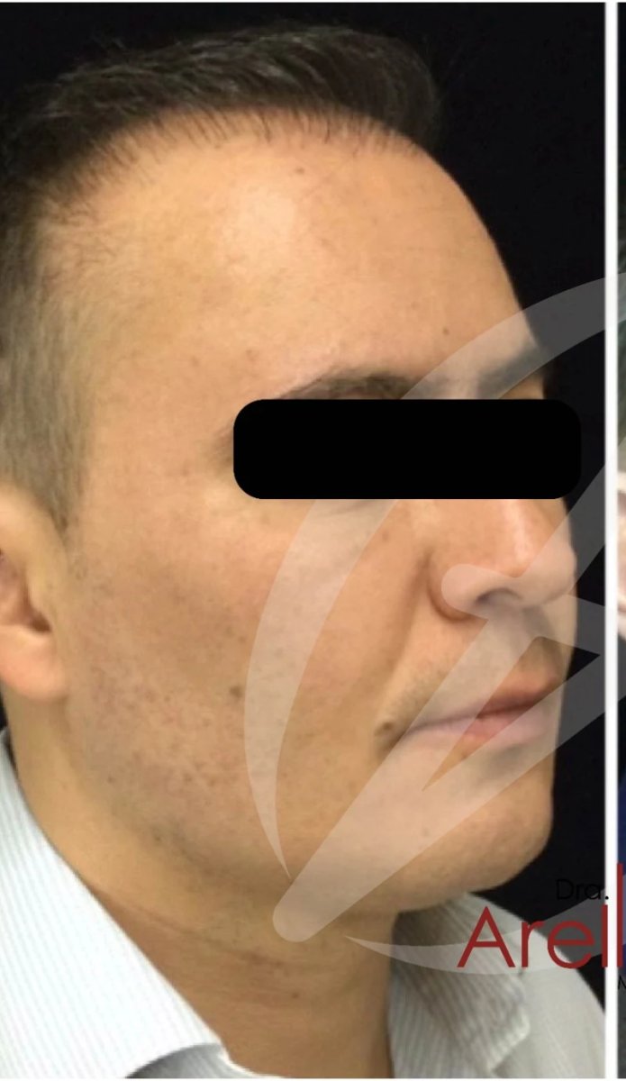 Jaw shaping result in male patient, improved jawline contour after procedure