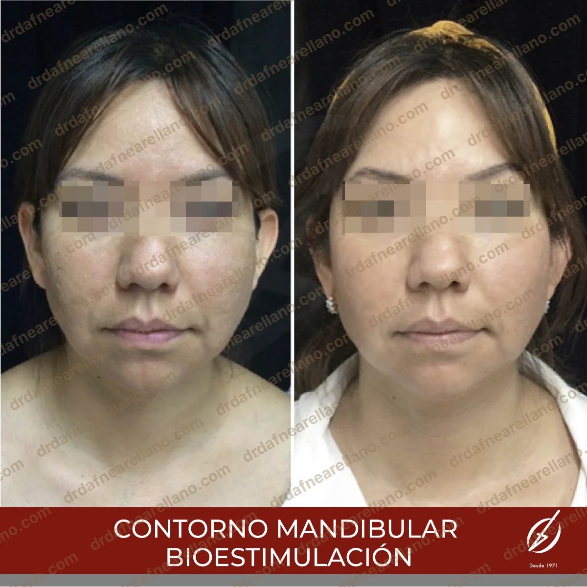 Before and after jaw shaping bio-stimulation results, improved jawline contour visible