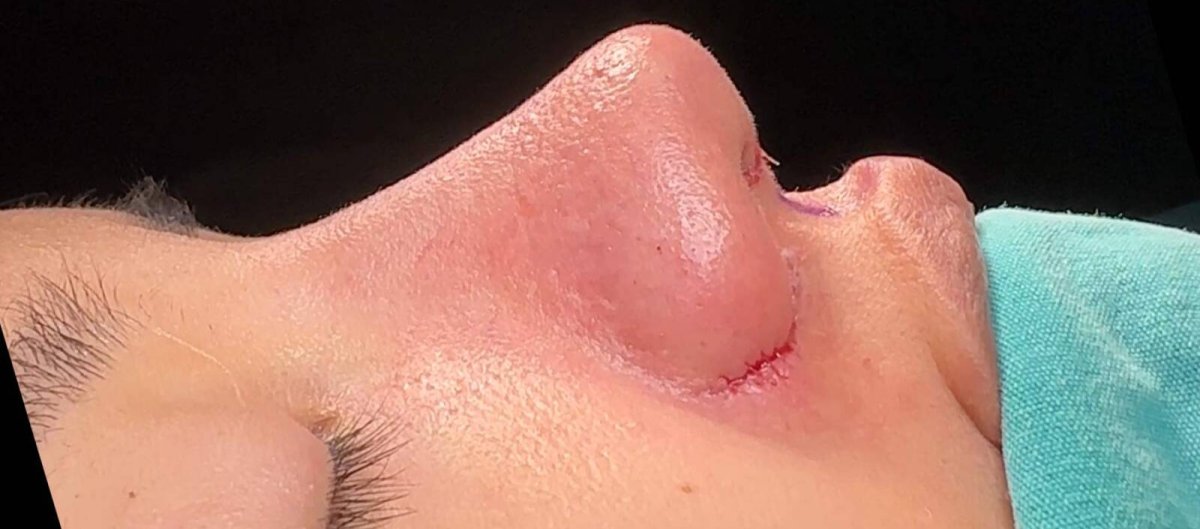 Rhinoplasty result with visible incision on nose, early healing stage after nose surgery