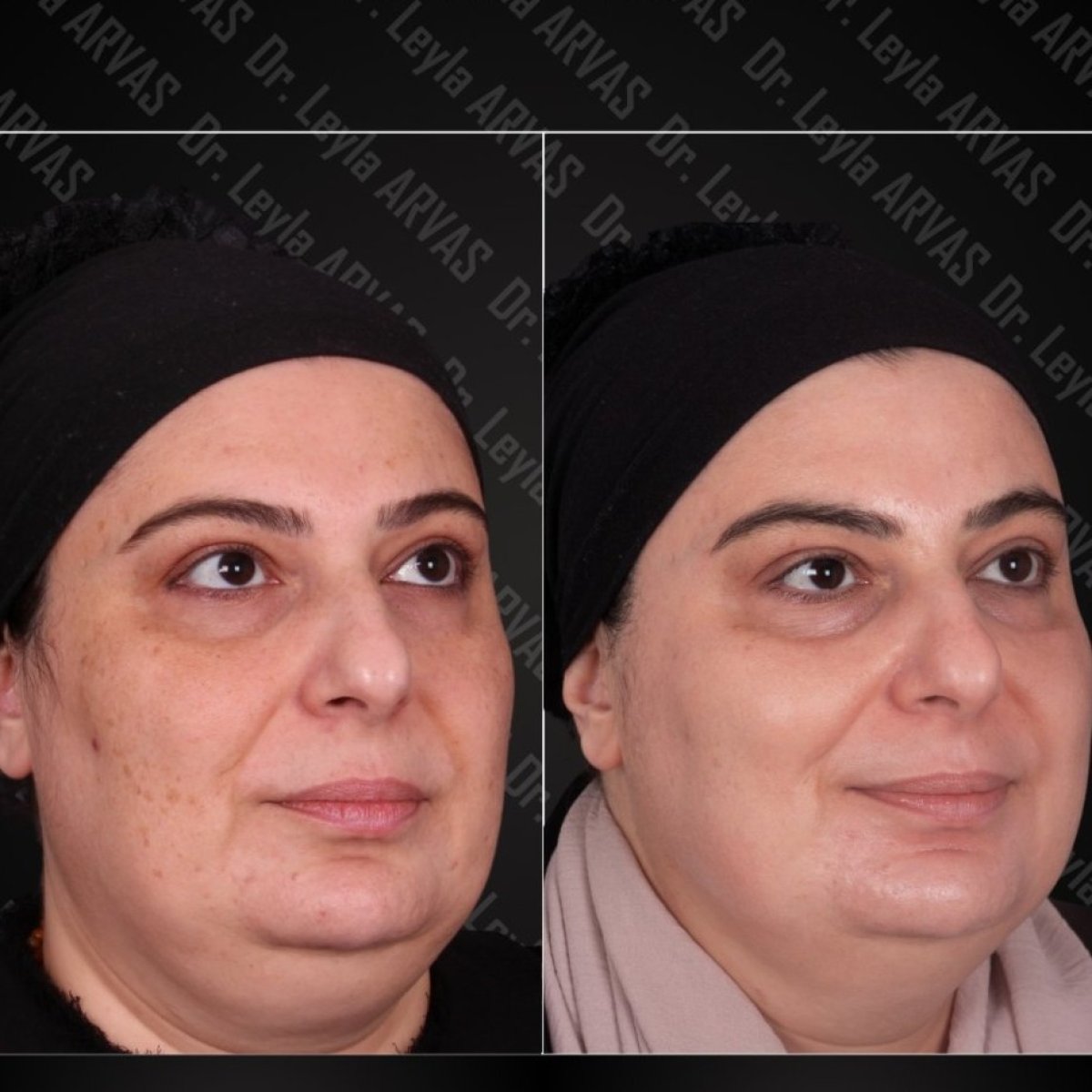Before and after IPL skin treatment results at Quartz Hospital, improved skin tone and texture