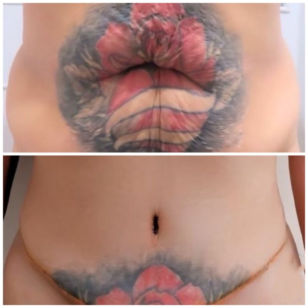 Before and after tummy tuck and liposuction results at Somchai Clinic, improved abdomen contour