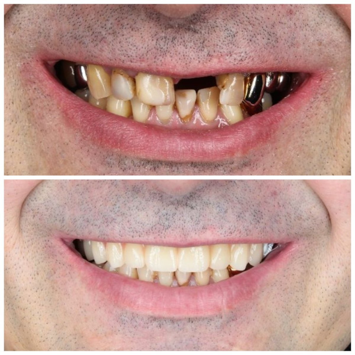 Before and after dental implant results at Dental Clinic Dynasty Stomatology in Krakow