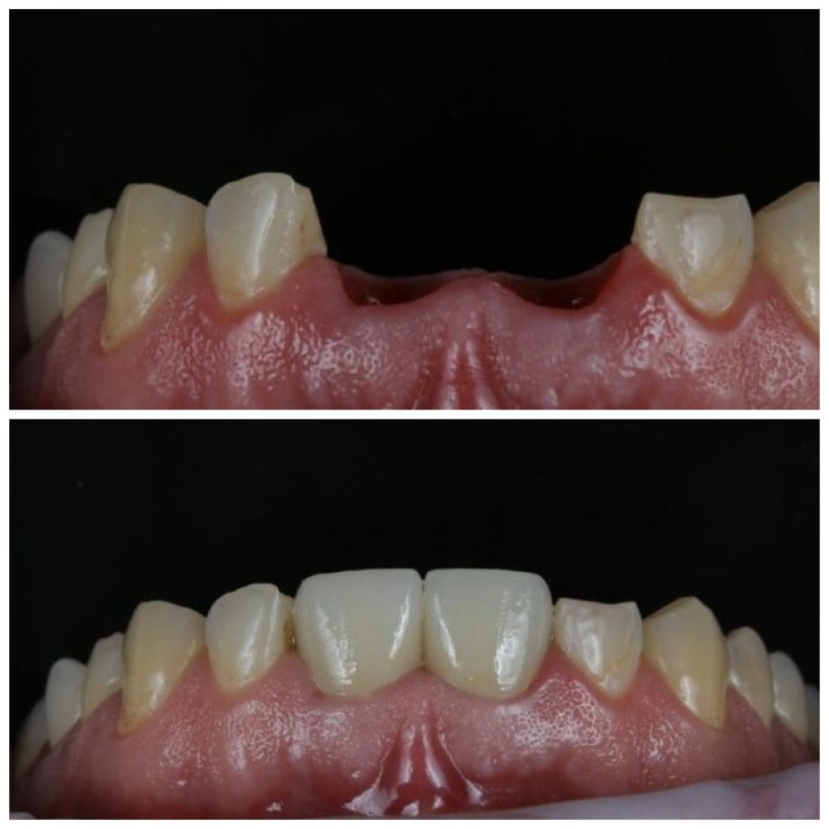 نتائج زراعة الأسنان قبل وبعد في عيادة Dynasty Stomatology في كراكوف