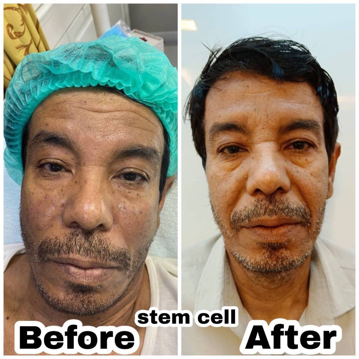 Before and after stem cell rejuvenation therapy result at ID Clinic Bangkok for anti-aging